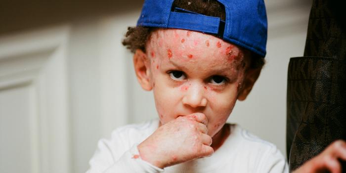 This is a photo of a young boy with Epidermolysis Bullosa (EB).
