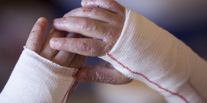 This is a photo of a child's bandaged hands.