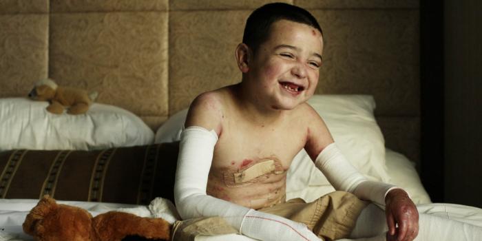 This photo is of a laughing boy with Epidermolysis Bullosa (EB).