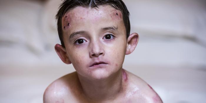 This photo is of a young boy with Epidermolysis Bullosa (EB).