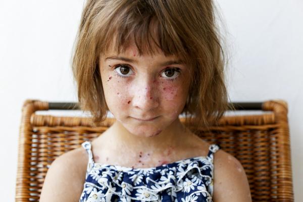 This is a photo of a young girl with Epidermolysis Bullosa (EB).