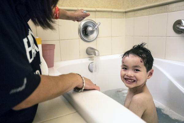 This picture is of a young boy with Epidermolysis Bullosa (EB) in a bath.
