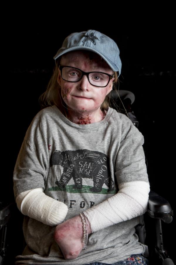 This picture is of a young woman living with Epidermolysis Bullosa (EB).