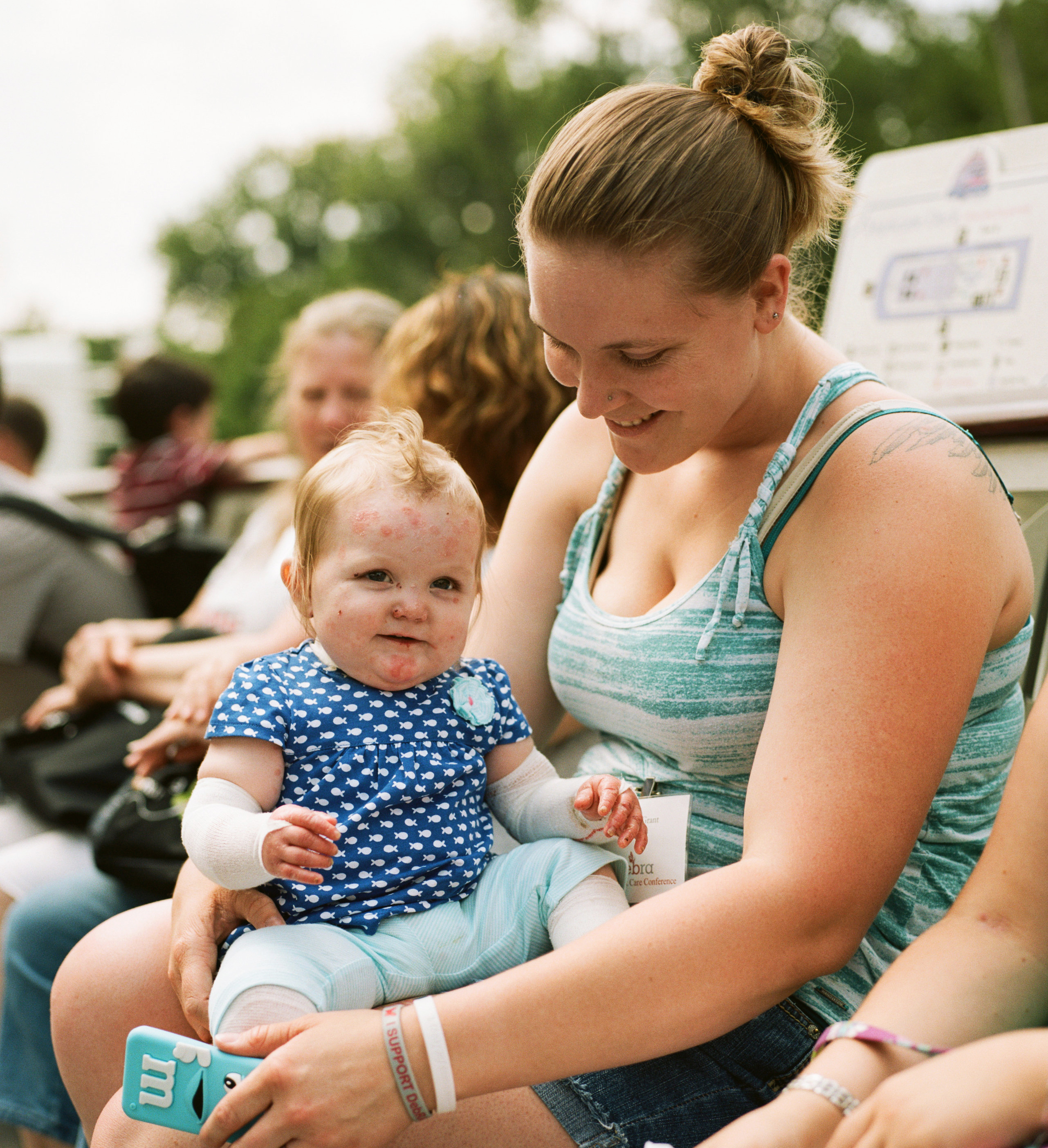debra of America Epidermolysis Bullosa Donate