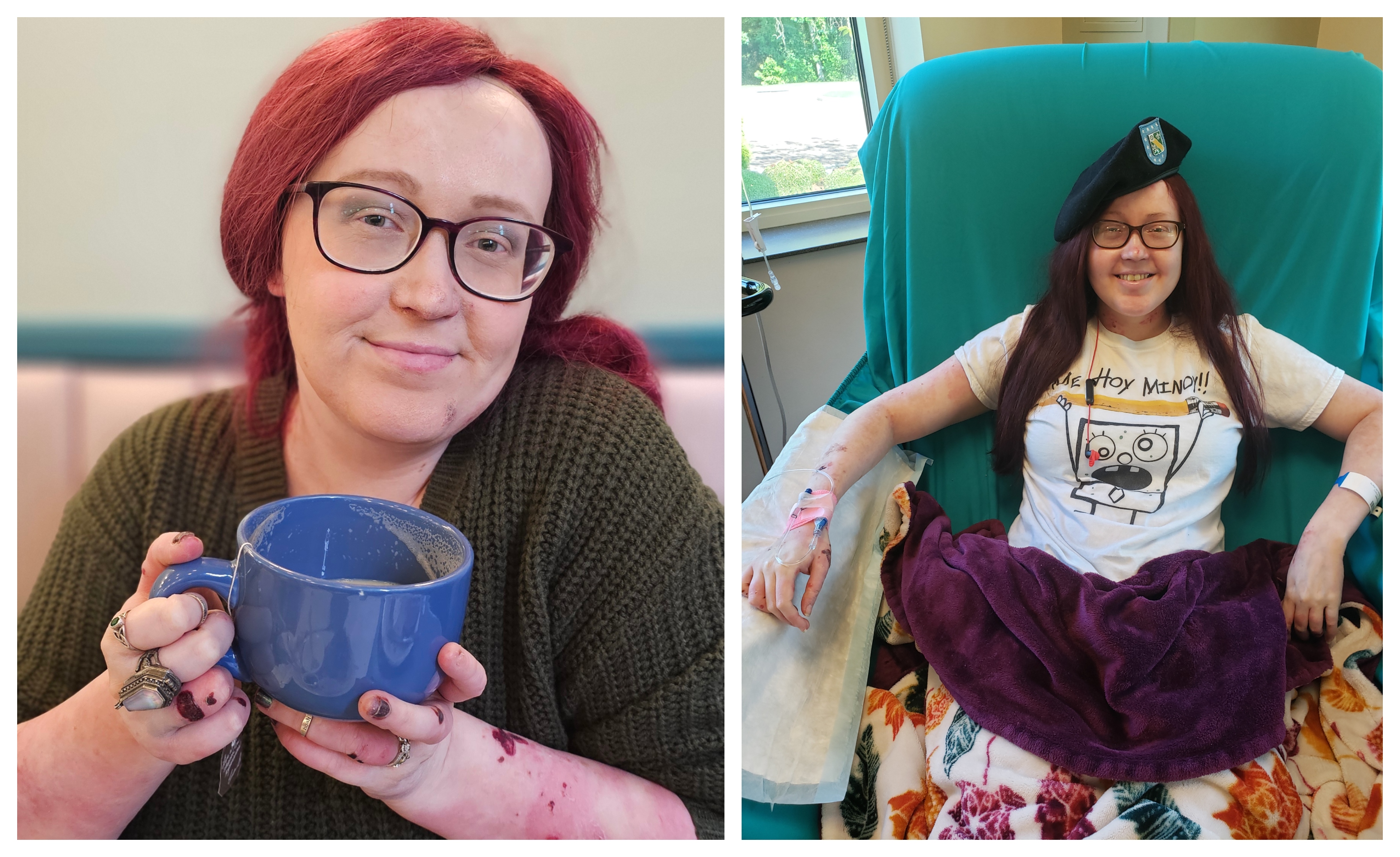 Epidermolysis Bullosa Personal Story