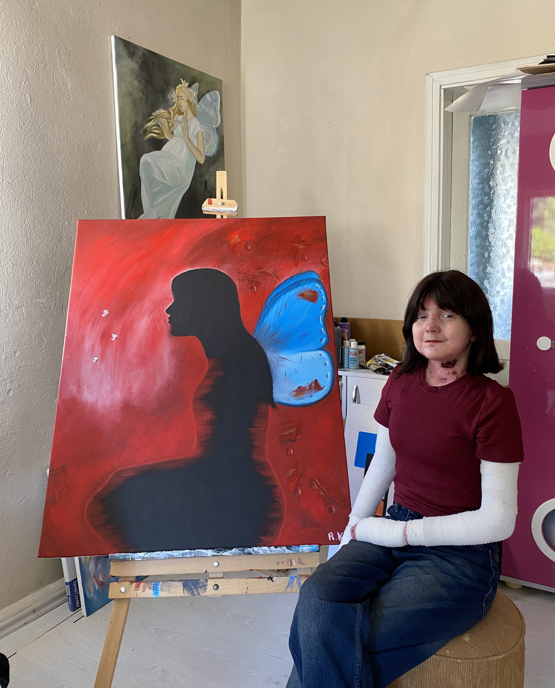 Personal Story Epidermolysis Bullosa