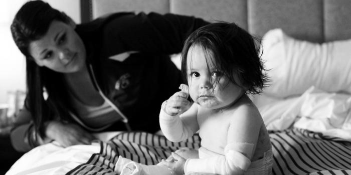 This is a photo of a baby with Epidermolysis Bullosa (EB) sitting on a bed with his mother..