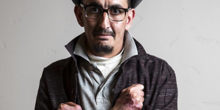 This photo is of a man with EB.