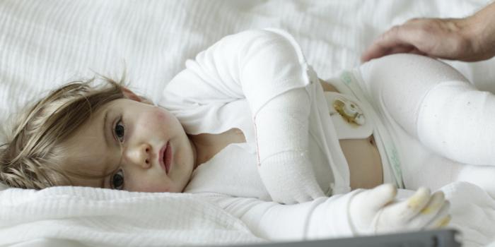 This photo is of a baby with EB laying down.