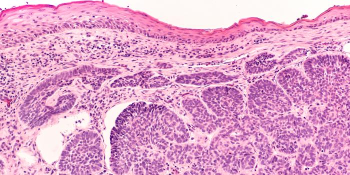 Epidermolysis Bullosa Management Guide Cancer