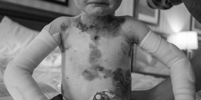 Epidermolysis Bullosa Management Guide Pain