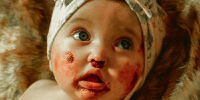 Junctional Epidermolysis Bullosa
