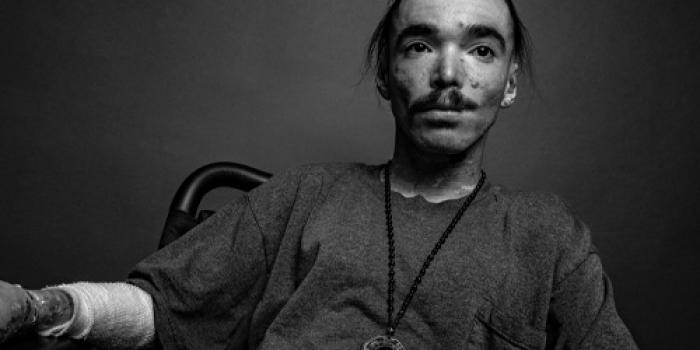 Dystrophic Epidermolysis Bullosa