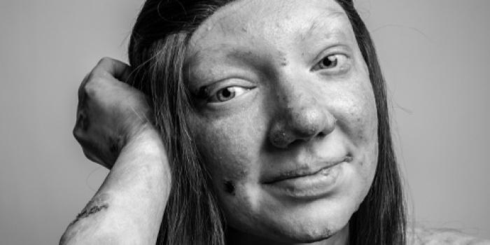 Junctional Epidermolysis Bullosa