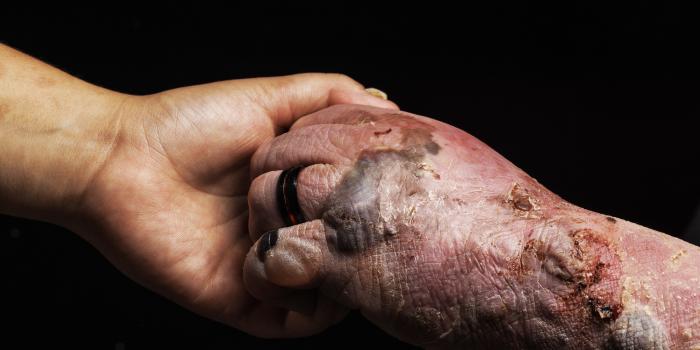 Epidermolysis Bullosa Awareness Week