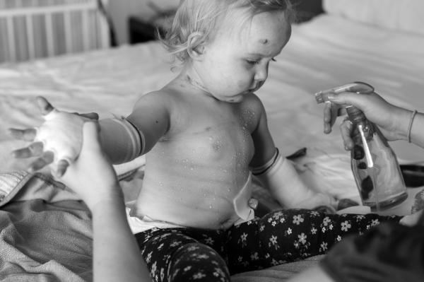 This photo is of a young girl during a bandage change.