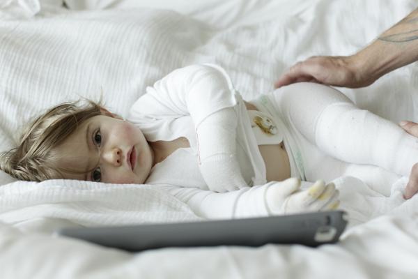 This photo is of a baby with Epidermolysis Bullosa (EB) laying on a bed.