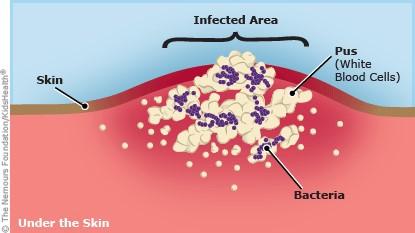 This is a diagram illustrating the components of a skin infection.