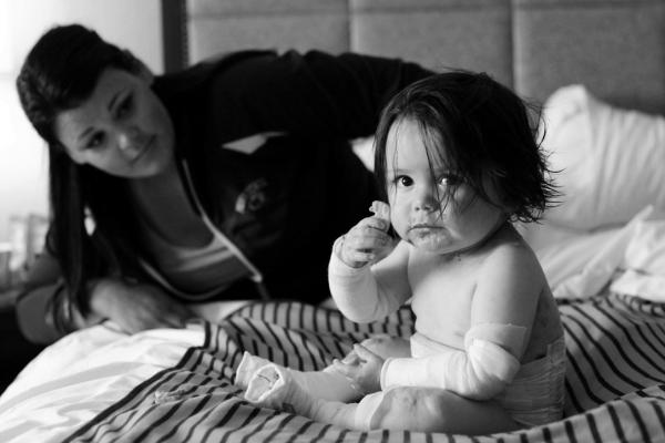 This picture is of a mom and son with Epidermolysis Bullosa (EB).