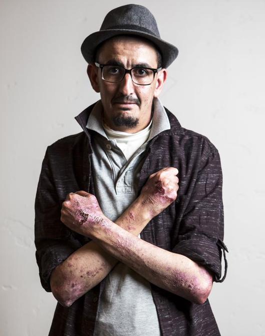 This photo is of Mohamed, a man with Epidermolysis Bullosa (EB).