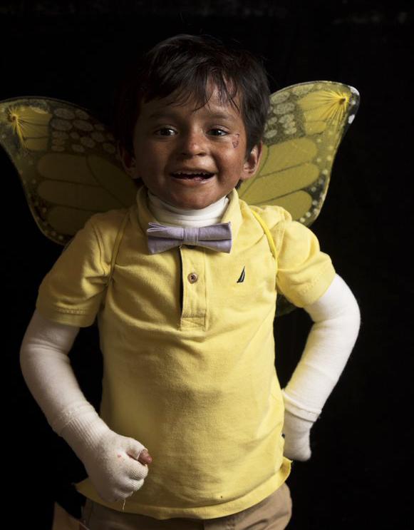 This photo is of Salim, a young boy with EB.