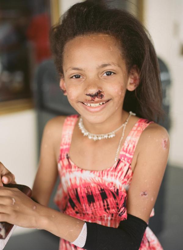 This photo is a young girl with Epidermolysis Bullosa (EB) smiling.