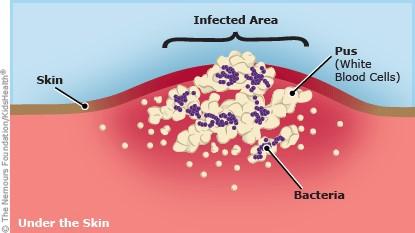 Epidermolysis Bullosa Infection