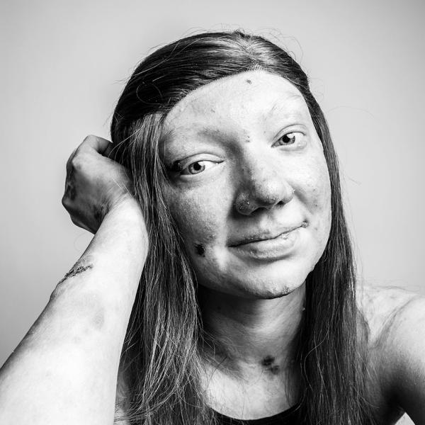 Epidermolysis Bullosa Personal Story