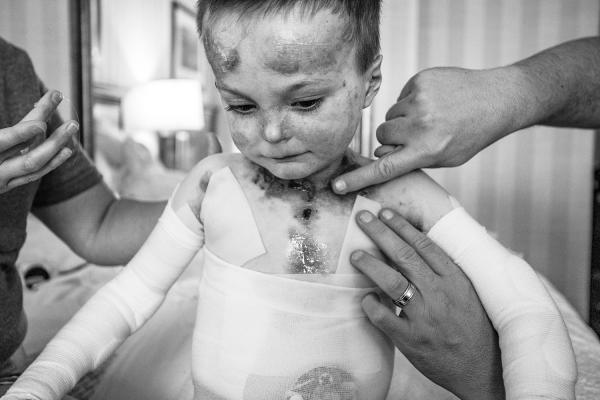 Epidermolysis Bullosa debra of America Donate