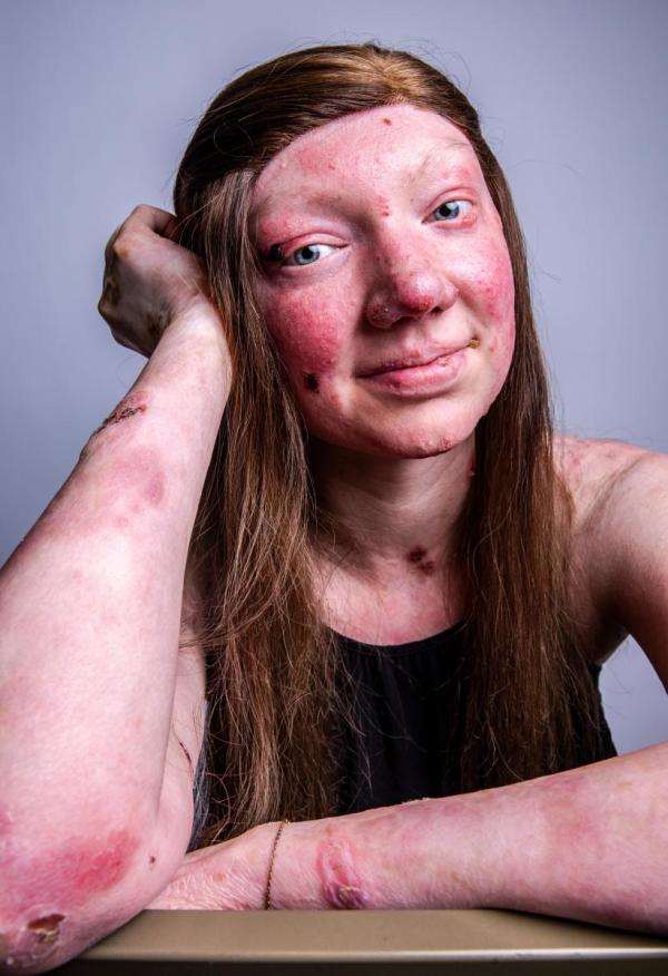 debra of America Epidermolysis Bullosa