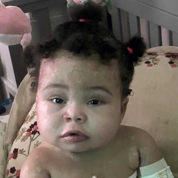 Epidermolysis Bullosa Personal Story